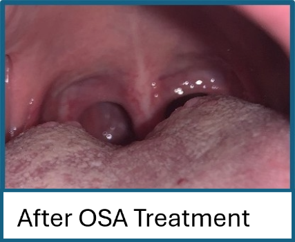 After OSA Treatment