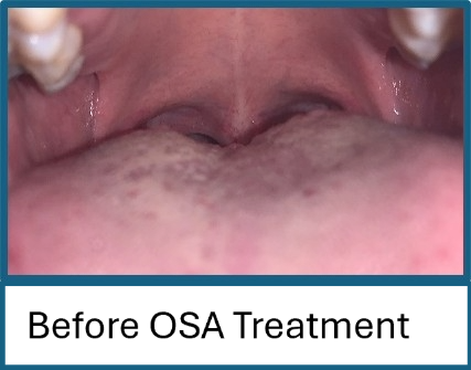 Before OSA Treatment